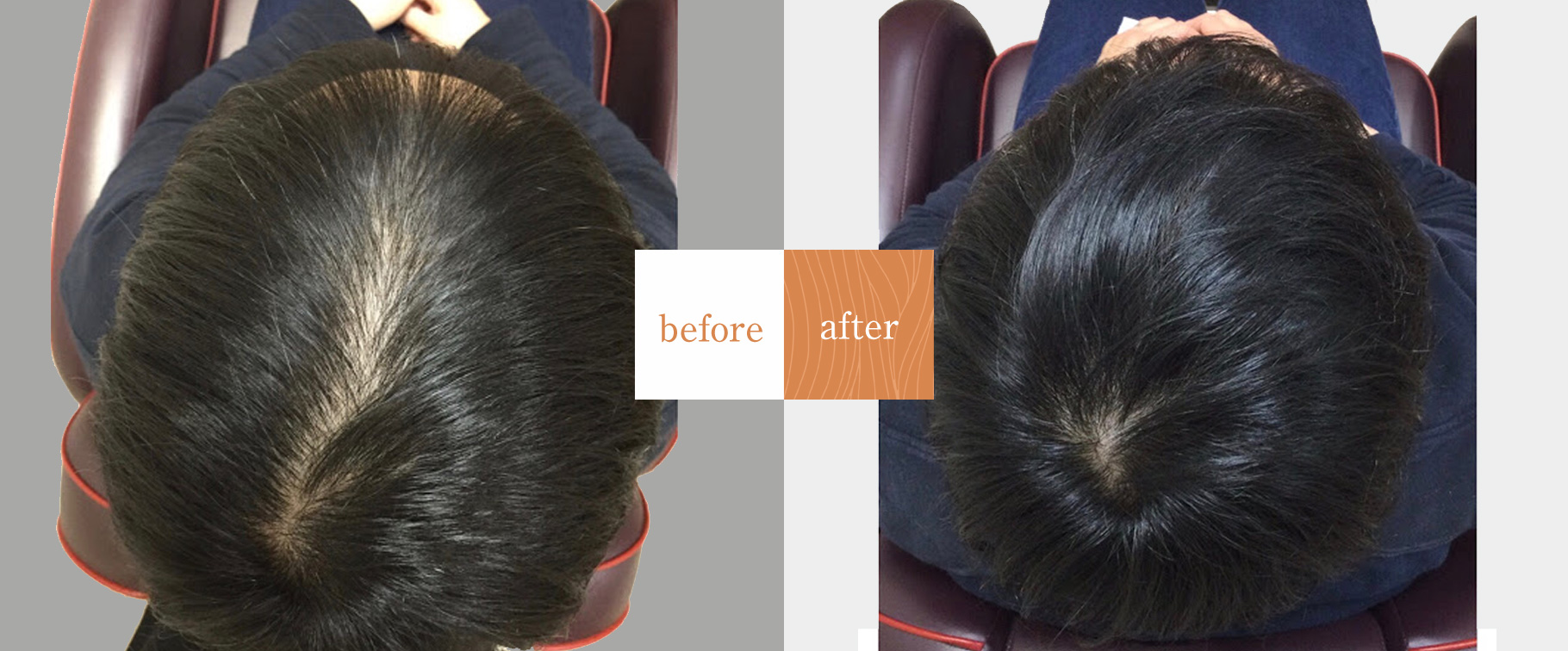 薄毛ケア専門サロン シャン美容室改善事例